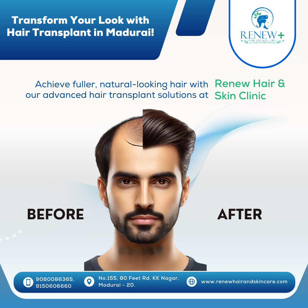 Hair transplant in madurai  Renew Hair and Skin Care - Tamil Nadu - Madurai ID1596361