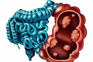 Best Malignant Intestinal Disease Treatment in Gujarat - Gujarat - Ahmedabad ID1595865
