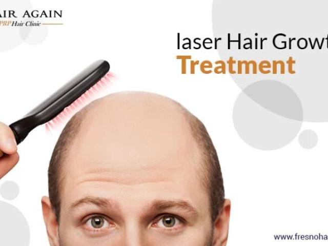 Laser Hair Replacement Therapy - California - Fresno ID1544274