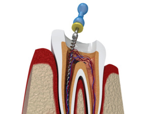 Best Root Canal Treatment in Kolkata at Teeth Care Multispec - West Bengal - Kolkata ID1592625