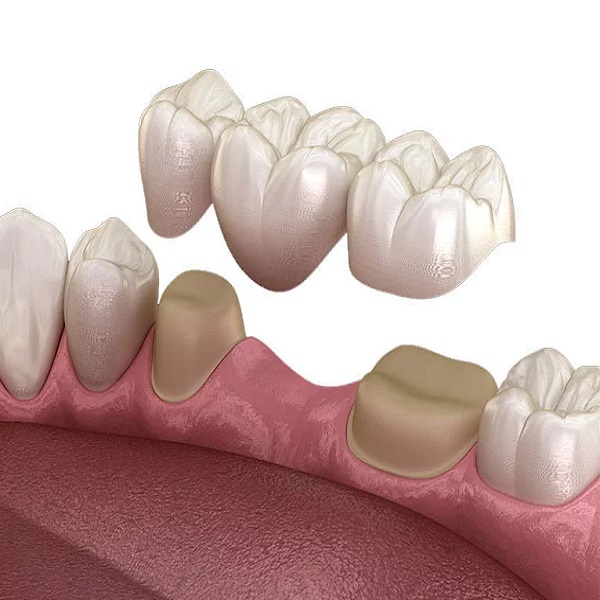 Best Cosmetic bridge clinic in Dubai UAE - Connecticut - Hartford ID1592083
