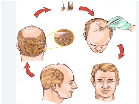  hair transplantation in  prayagraj  uttar pradesh - Uttar Pradesh - Allahabad ID1513237