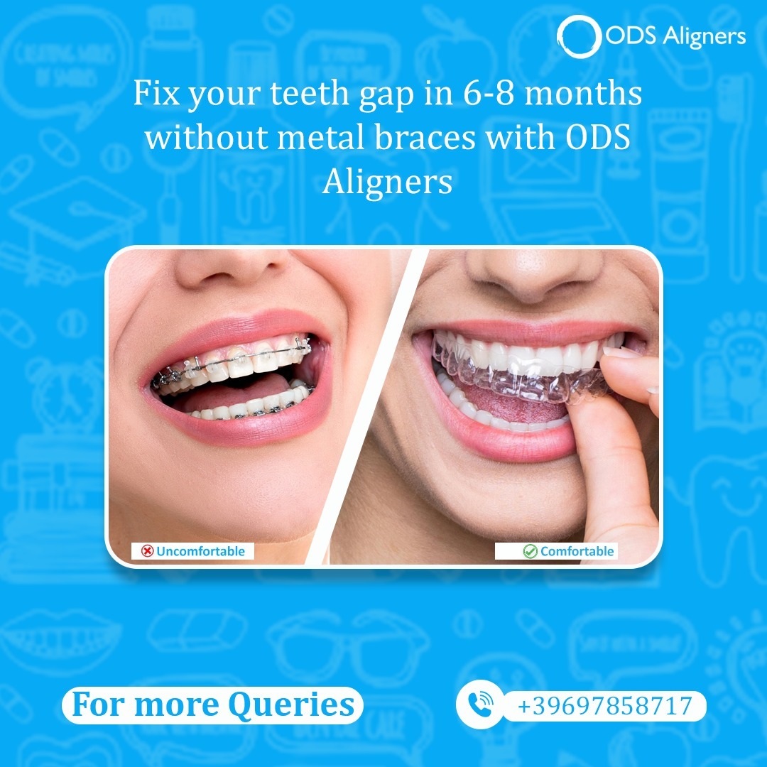 Top Myths about Teeth Aligners Debunked - Uttar Pradesh - Noida ID1516211