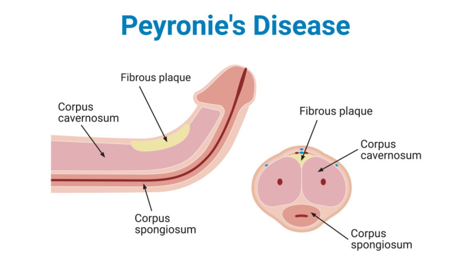 Peyronies Disease Chicago - Illinois - Chicago ID1594994 2
