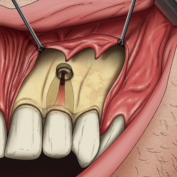 Best Periapical surgery treatment in Dubai UAE - Colorado - Colorado Springs ID1589673