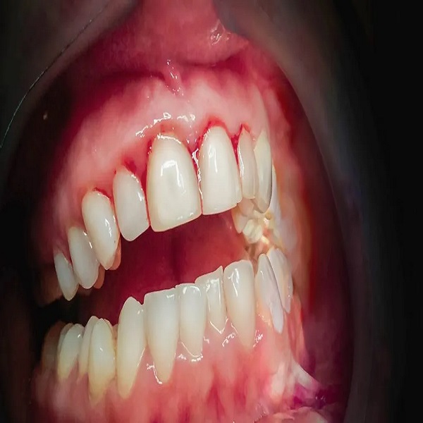 Best Gingivitis clinic in Dubai UAE - Nebraska - Omaha ID1587336