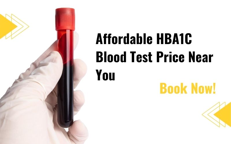HbA1c Blood Test Purpose Normal Range  Price Details - Delhi - Delhi ID1610643