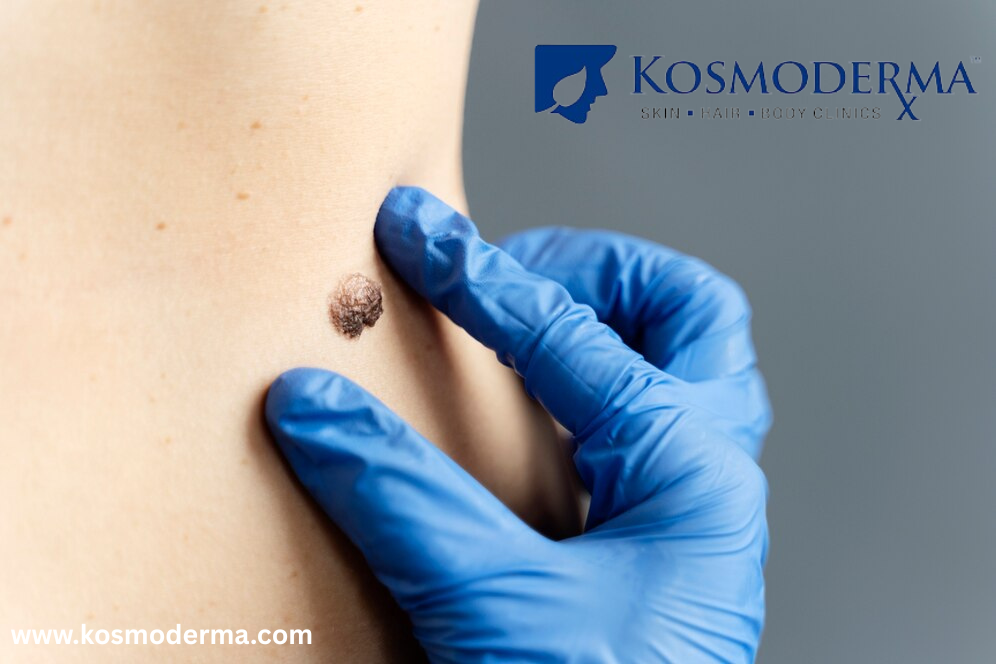 Leading Warts Removal Treatment in Bangalore  Kosmoderma Cl - Karnataka - Bangalore ID1600787