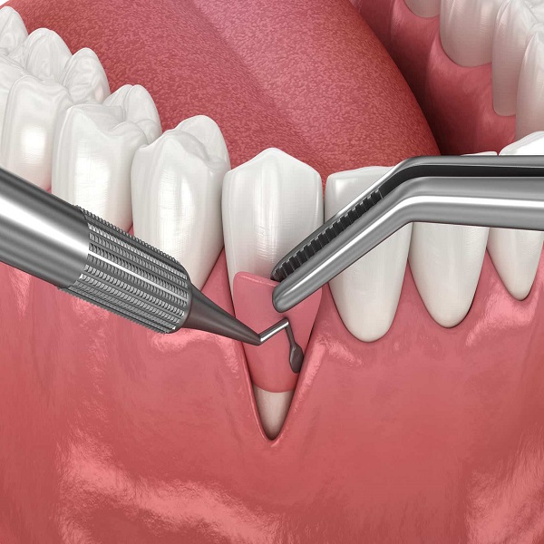 Best Gum Grafting clinic in Dubai UAE - Arizona - Gilbert ID1595555