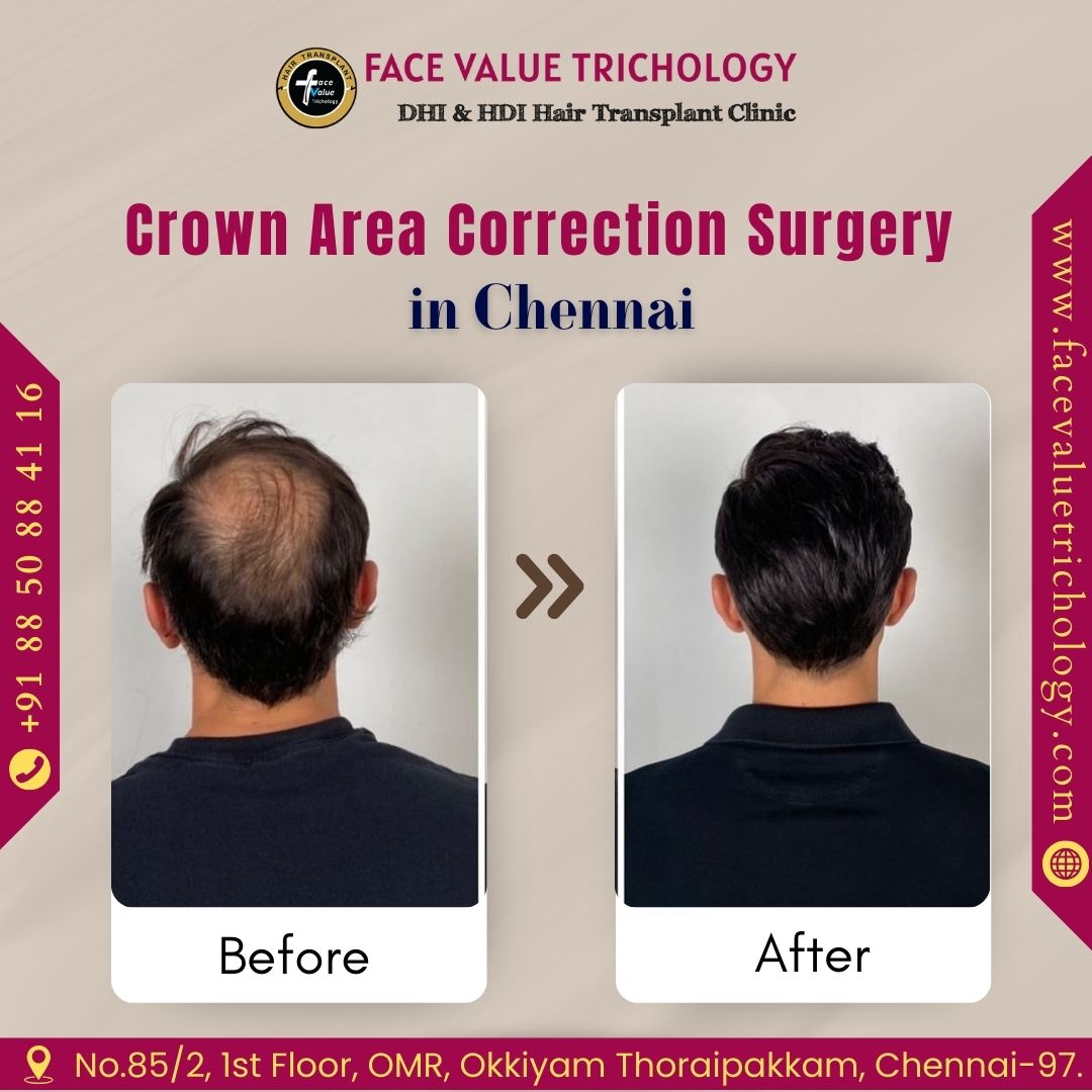 Top Hair Replacement Services in Chennai - Tamil Nadu - Chennai ID1596099