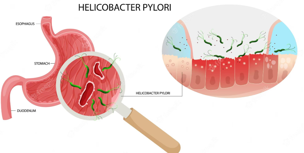 Effective Helicobacter Pylori Treatment - California - Santa Ana ID1555741