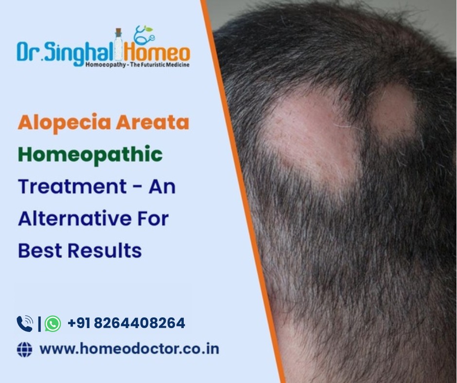 Exploring Homeopathic Medicine for Alopecia Areata Treatment - Chandigarh - Chandigarh ID1540641