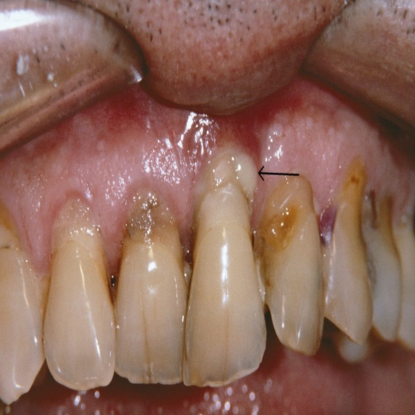 Best Gum disease treatment in Dubai UAE - Colorado - Colorado Springs ID1586475