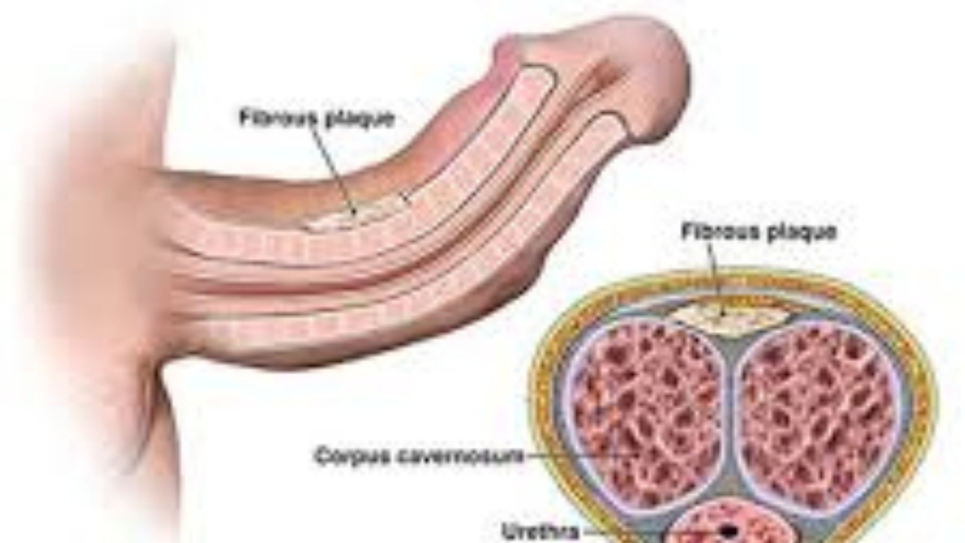 Peyronies Disease Chicago - Illinois - Chicago ID1594994