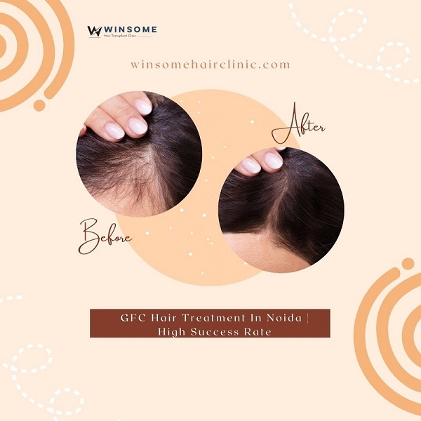 GFC Hair Treatment In Noida  High Success Rate - Uttar Pradesh - Noida ID1591905