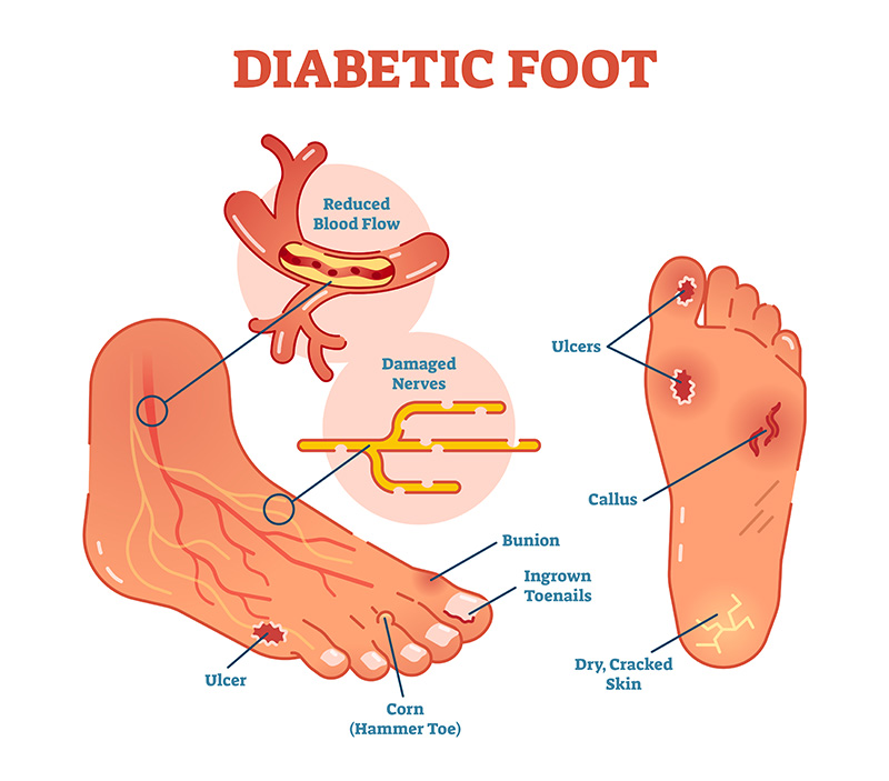 Advanced Diabetic Wound Care NYC  Oleg Karpenko Podiatry PC - New York - Brooklyn ID1605039 2