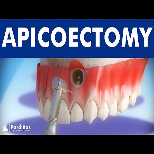 Best apicoectomy treatment in Dubai UAE - California - Carlsbad ID1587951