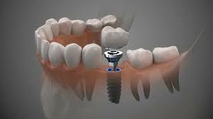 Best Full Mouth Dental Implant Service in Kolkata - West Bengal - Kolkata ID1593723