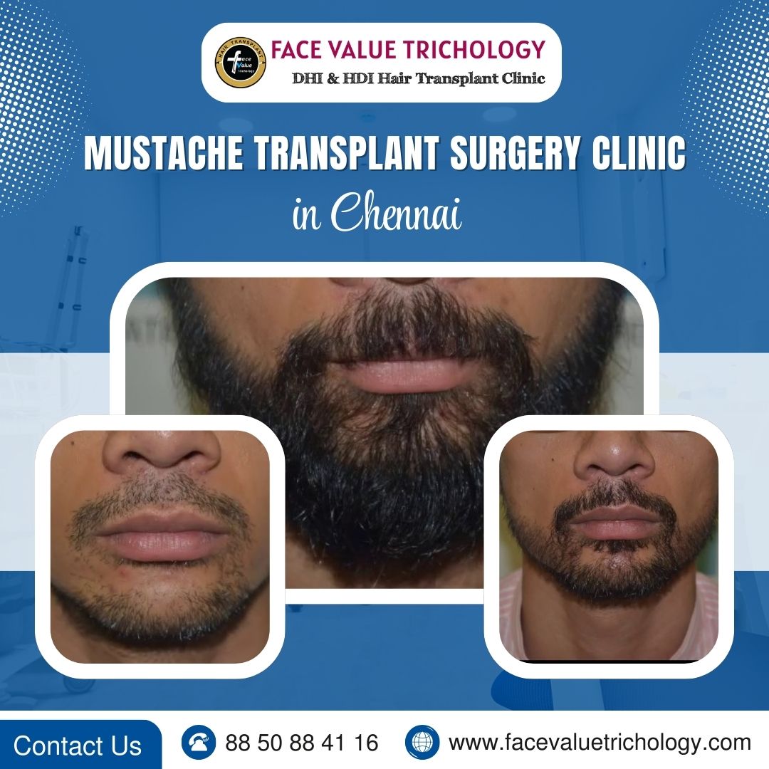 Best Beard Transplant Clinic in Chennai - Tamil Nadu - Chennai ID1603832