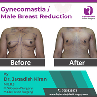 Top Gynecomastia treatment in Hyderabad 2024 - Andhra Pradesh - Hyderabad ID1536709
