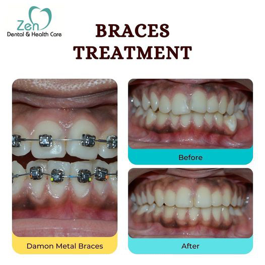 Best Dental Braces Treatment in Bangalore - Karnataka - Bangalore ID1547592