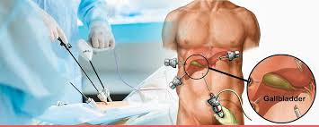 Best Doctor for Gallbladder Stone Surgery in Kolkata - West Bengal - Kolkata ID1592115