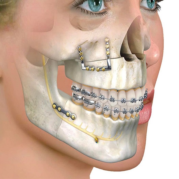 Best Jaw surgery clinic in Dubai UAE - Connecticut - Stamford ID1590146