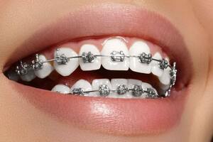 Get Perfectly Aligned Teeth with Braces at Teeth Care Multis - West Bengal - Kolkata ID1592781