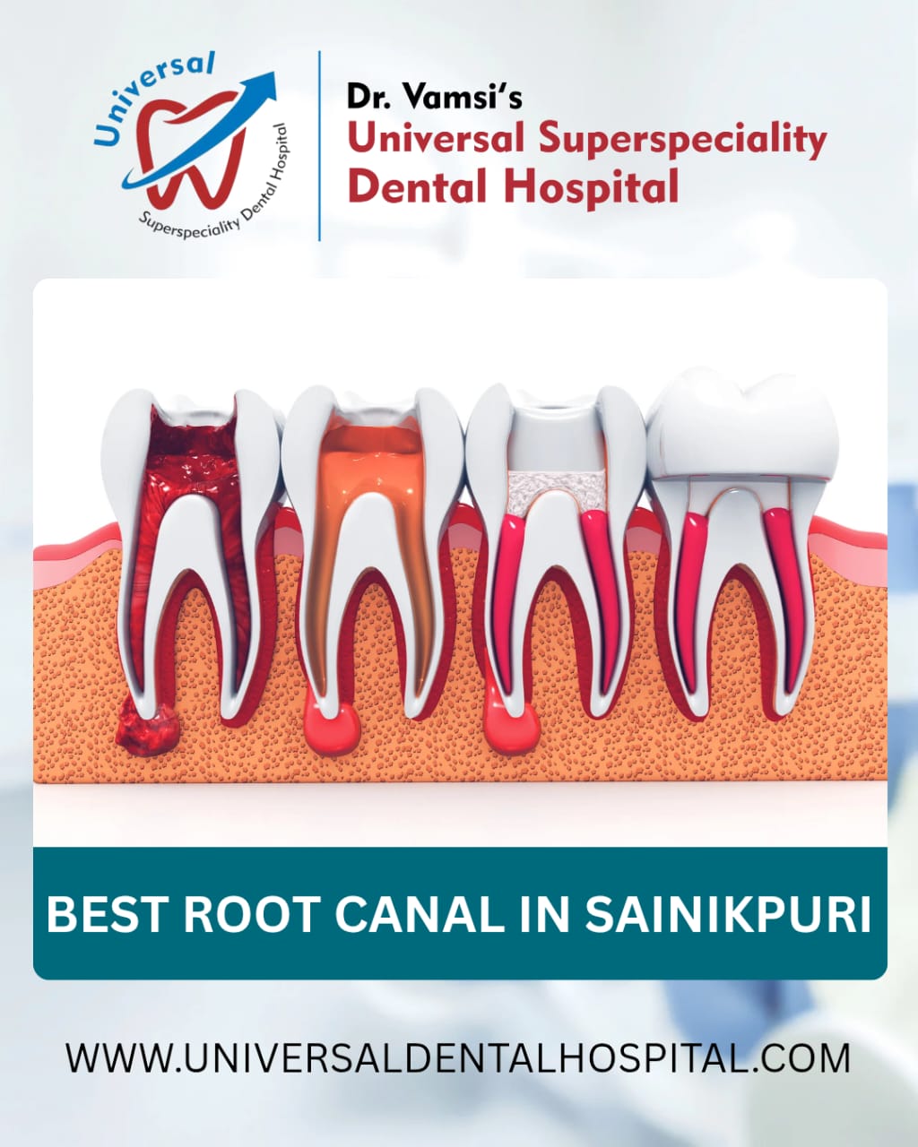 Top Reasons to Choose a Root Canal Specialist Over a General - Andhra Pradesh - Hyderabad ID1609204