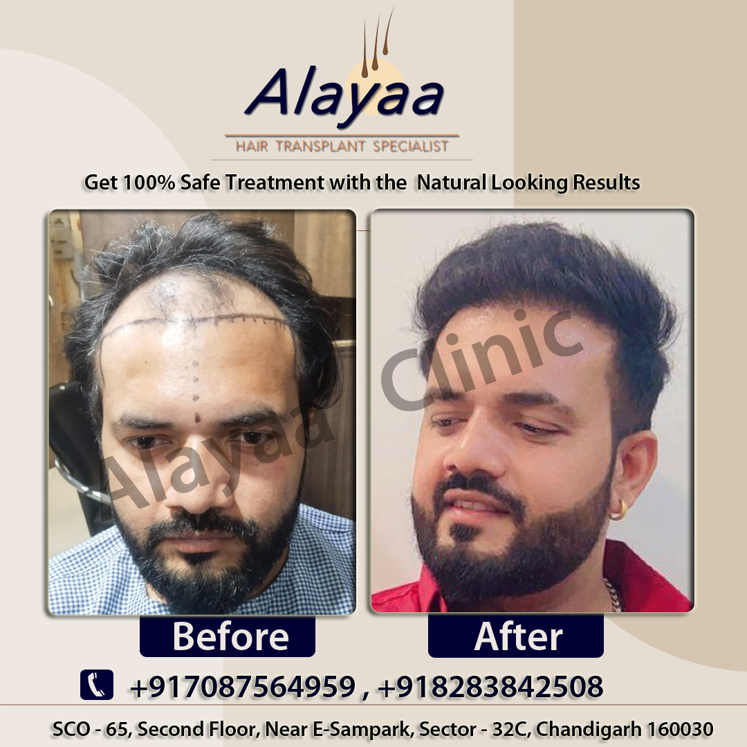 How to Choose a Hair Transplant Specialist in Chandigarh - Chandigarh - Chandigarh ID1595569