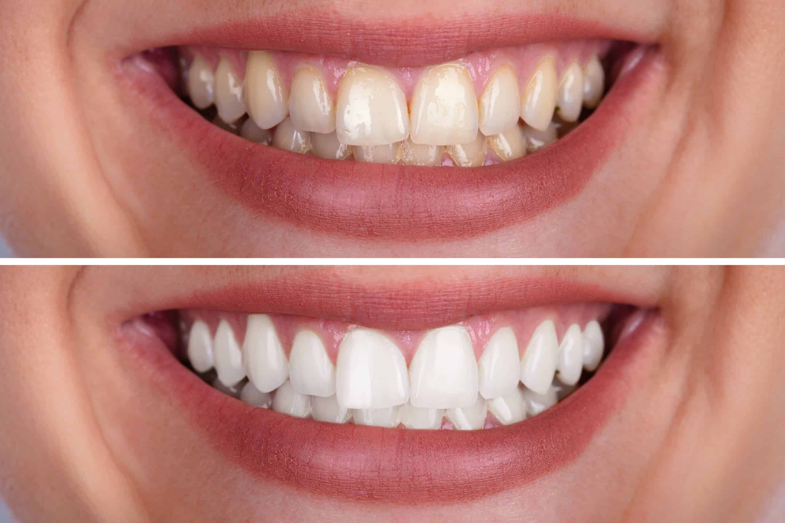 Teeth Whitening  Bleaching  - Maharashtra - Pune ID1556455 1