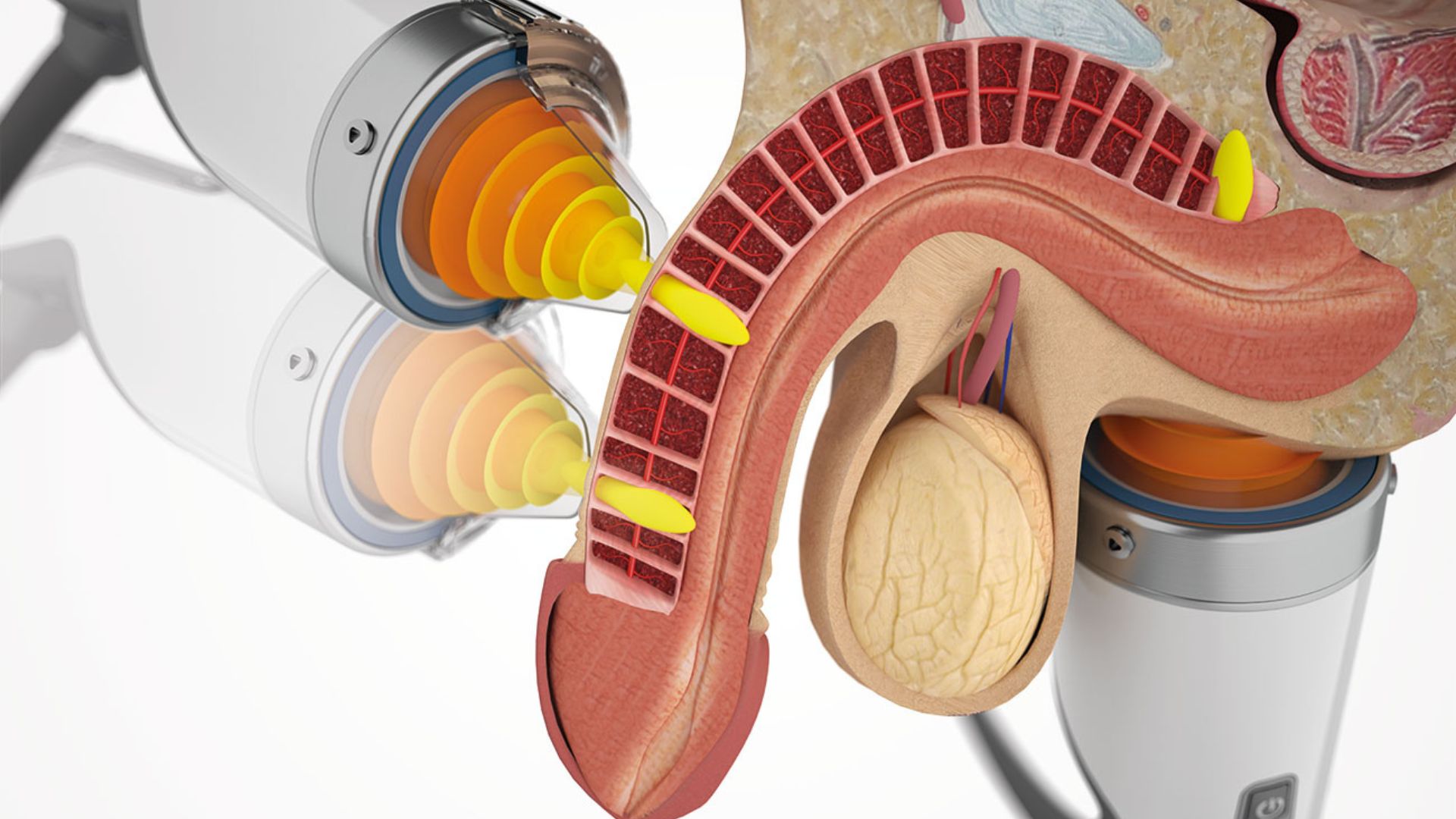 Treatment Options For Erectile Dysfunction - California - San Diego ID1587932 3