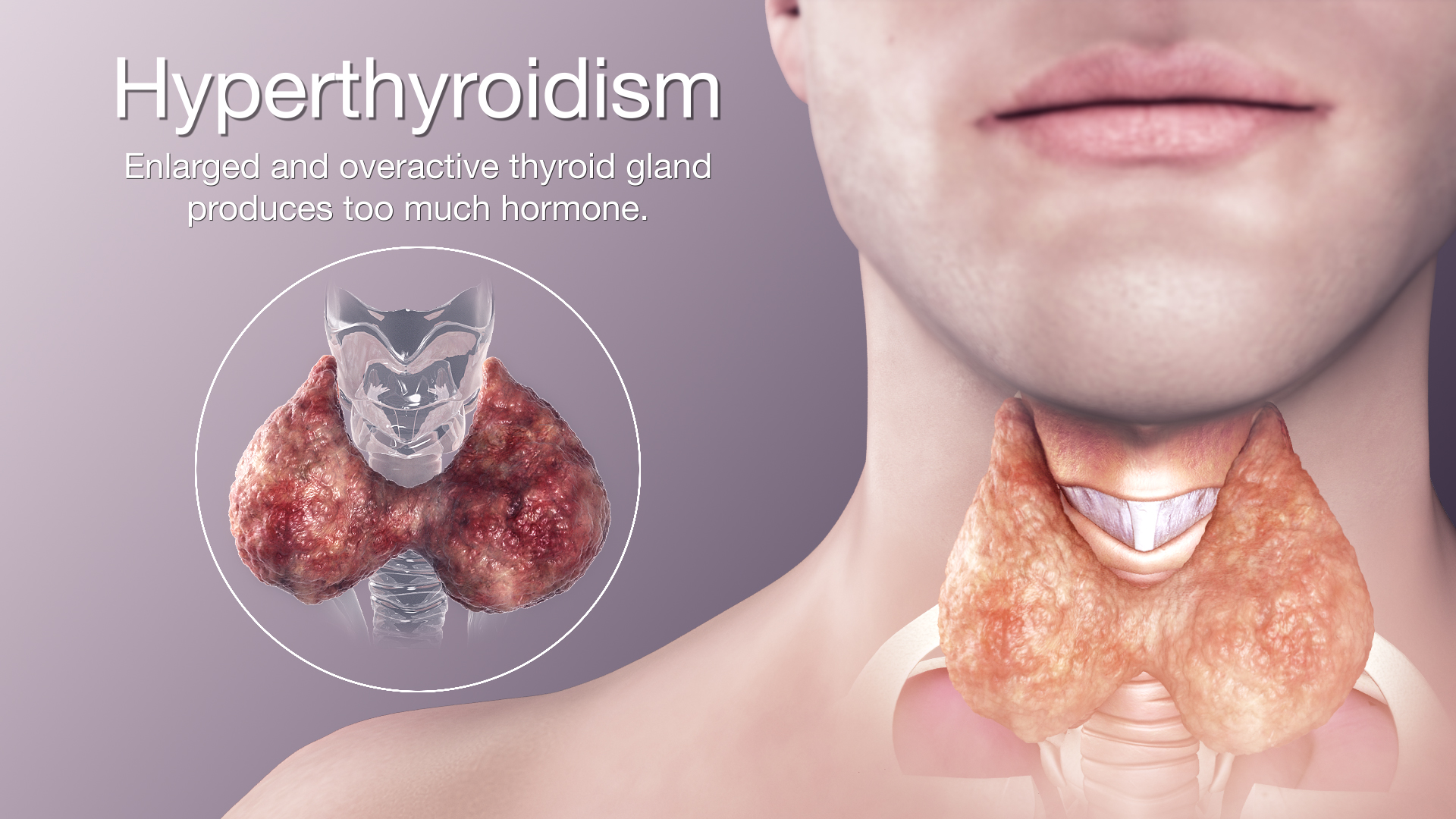 Discover Relief Expert Hyperthyroidism Treatment in NYC - New York - New York ID1551603 2