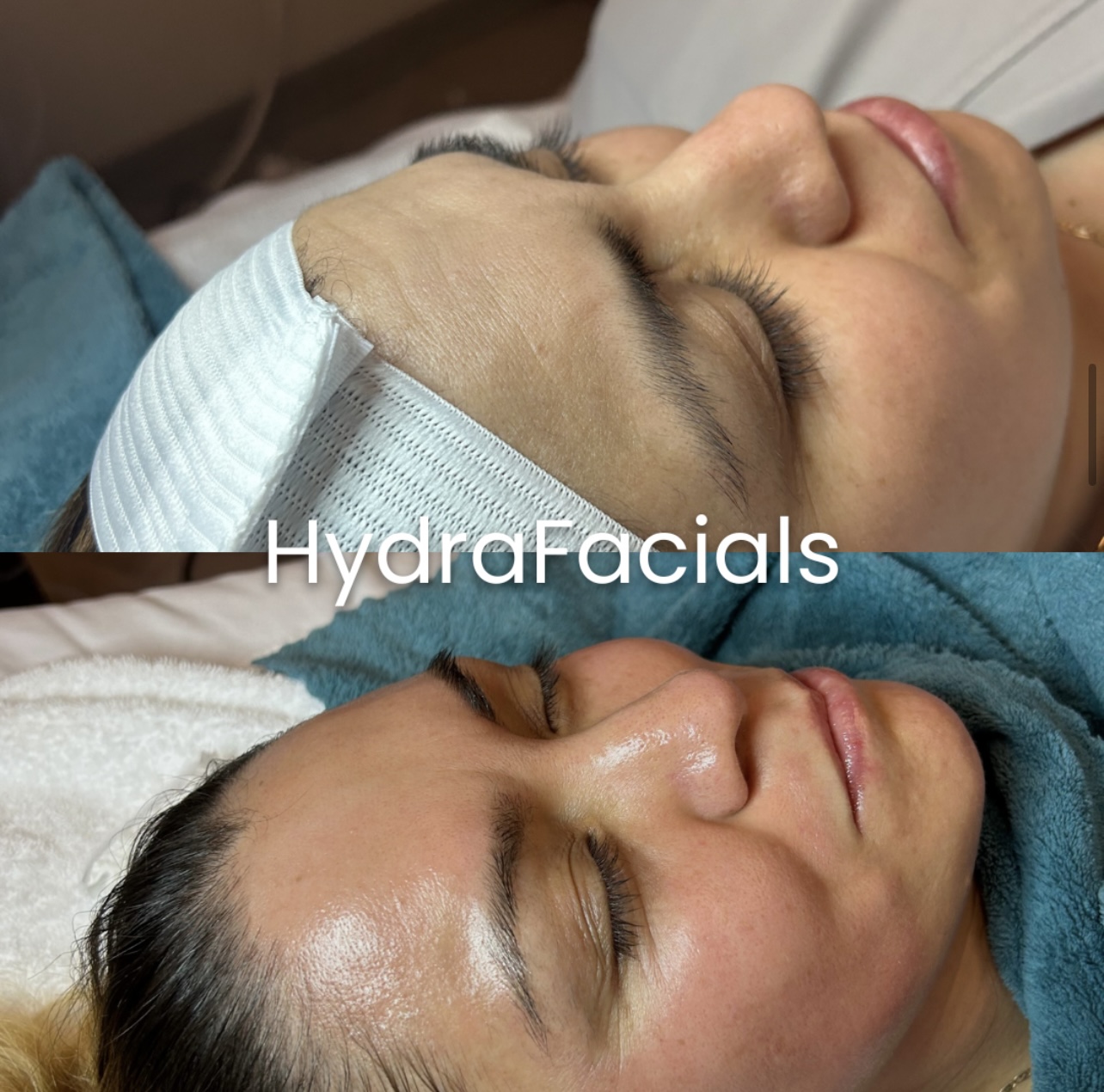 Hydrafacial overland park ks - Kansas - Overland Park ID1611160 2