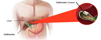 Expert Gallbladder Cancer Treatment in Ludhiana - Punjab - Ludhiana ID1591263
