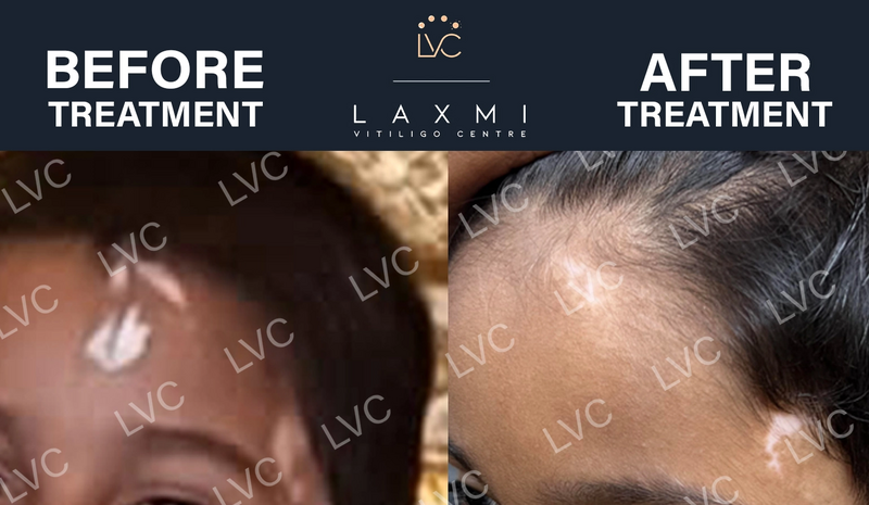 Best Doctor  Best Homeopathic Vitiligo Treatment and Packs - Tamil Nadu - Madurai ID1609480