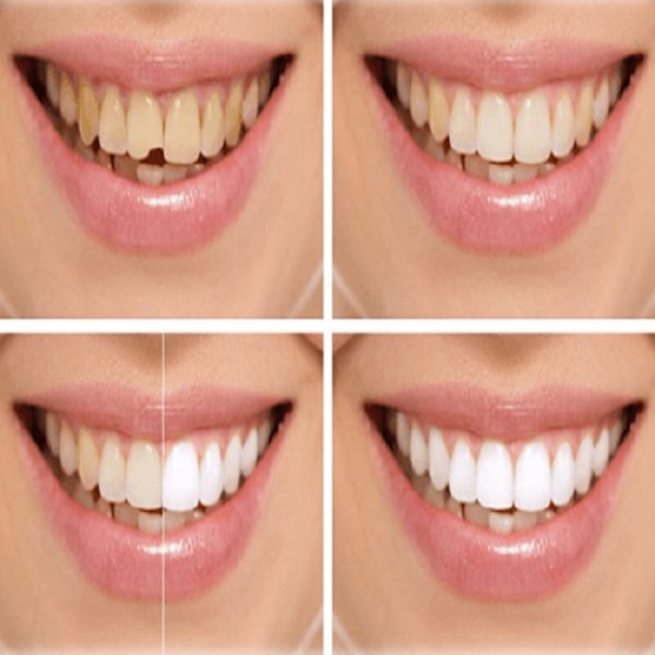 Best Cosmetic bonding treatment in Dubai UAE - California - Chico ID1593412
