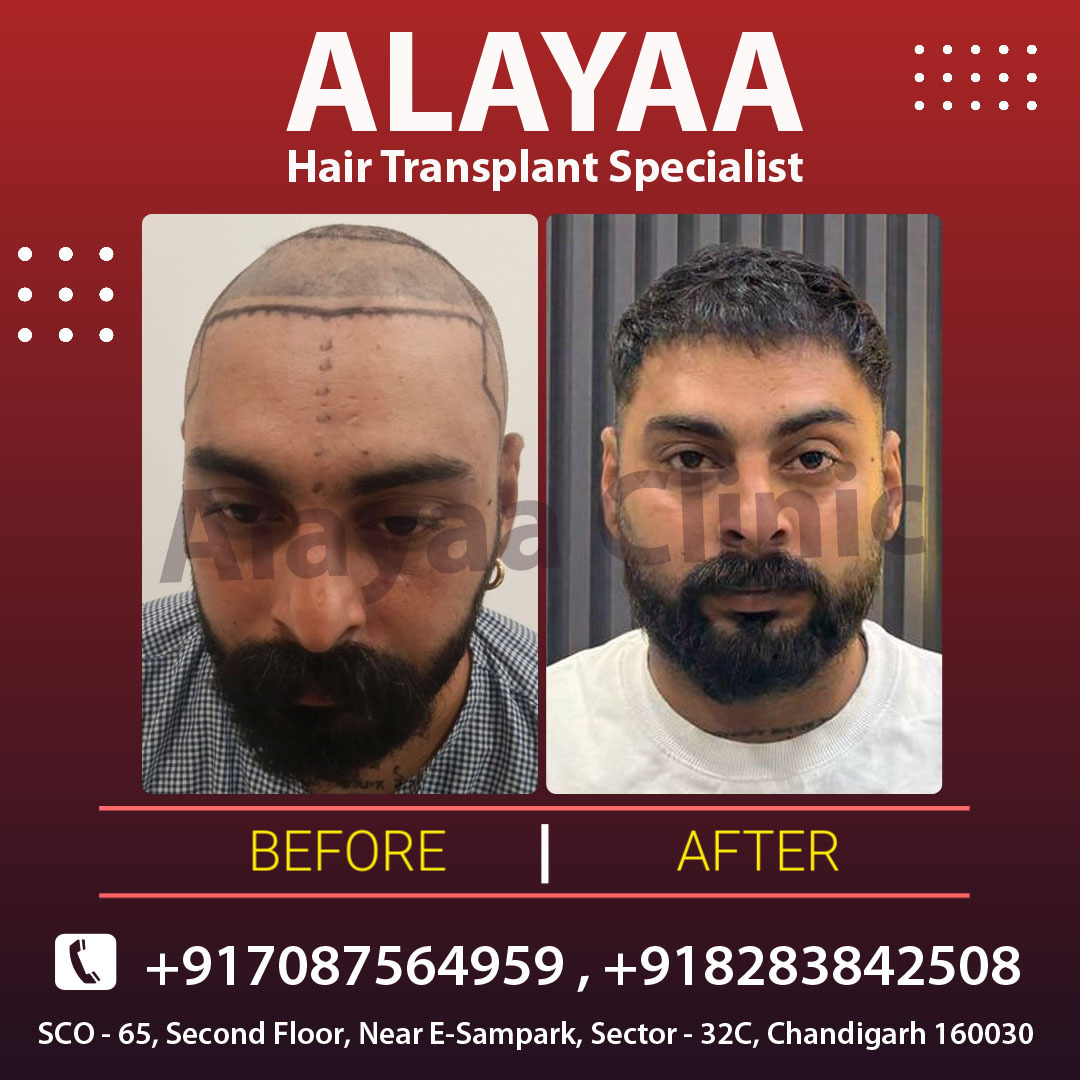 Steps to Prepare for a Best Hair Transplant Clinic in Chandi - Chandigarh - Chandigarh ID1598114