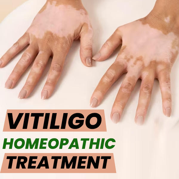 Vitiligo homeopathic treatment - Haryana - Gurgaon ID1517529