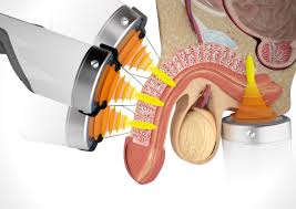 ED Wave Therapy - Illinois - Chicago ID1589694