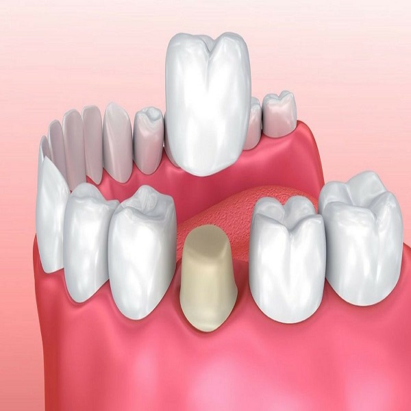 Best Cosmetic crown clinic in Dubai UAE - Connecticut - Stamford ID1591652