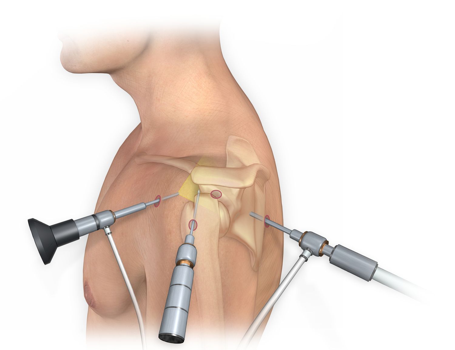Total Joint Replacement Surgery - Gujarat - Ahmedabad ID1533133