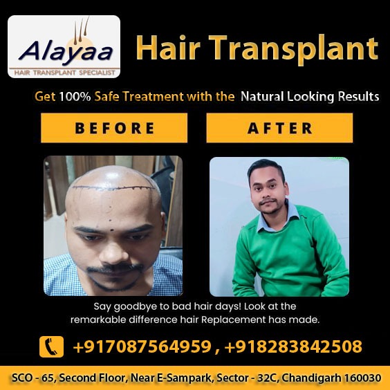 Hair Transplant in Chandigarh Expert Solutions for Natural H - Chandigarh - Chandigarh ID1541373