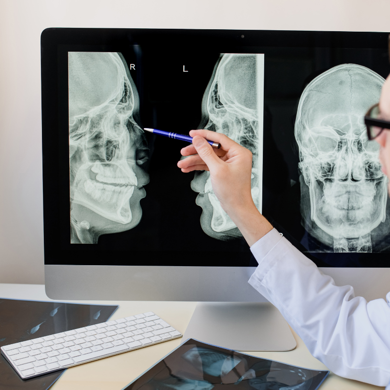 Fracture Nasal Bone Treatment - Punjab - S.A.S. Nagar ID1619647