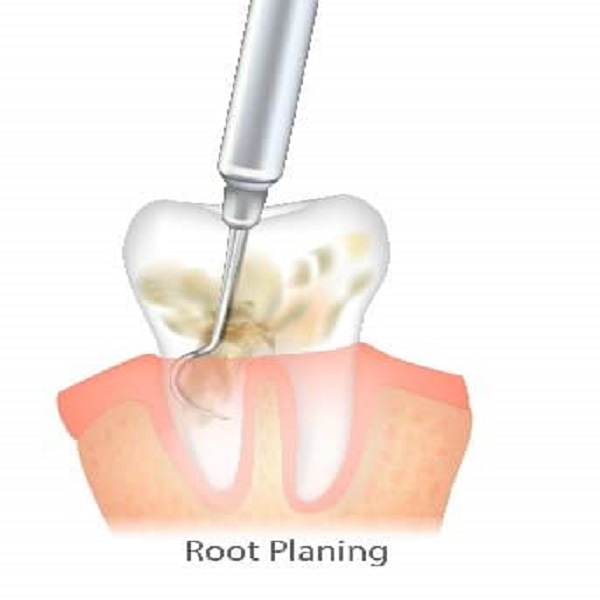 Best Root planning clinic in Dubai UAE - Arizona - Chandler ID1586950