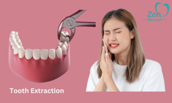 Tooth Extraction Service in Sarjapur Road Bangalore  Zen - Karnataka - Bangalore ID1585719