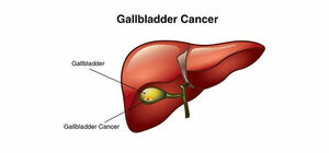 Best Gallbladder Cancer Treatment in Ludhiana - Punjab - Ludhiana ID1595866