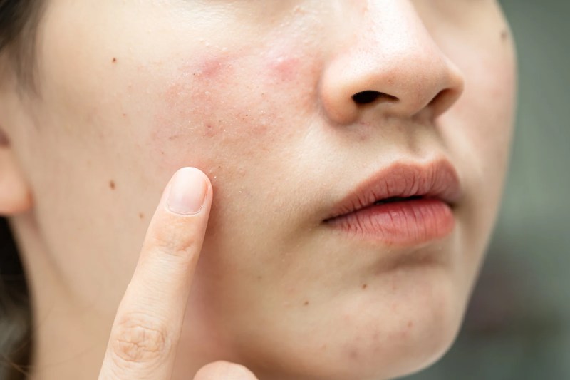 Best Acne Scar Treatment 2025  Saluja Skin CLinic - Chhattisgarh - Bilaspur ID1609977