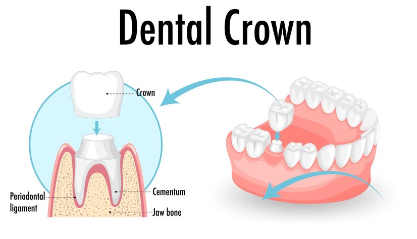 Dental Crowns Treatment  Cost in Mumbai - Maharashtra - Mumbai ID1556223 1