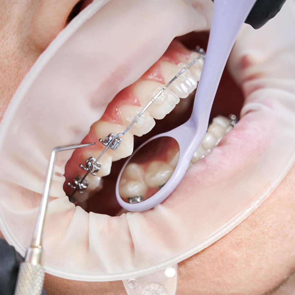 OrthodonticBraces Treatment - Gujarat - Surat ID1555586 1